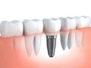 image of dental implant